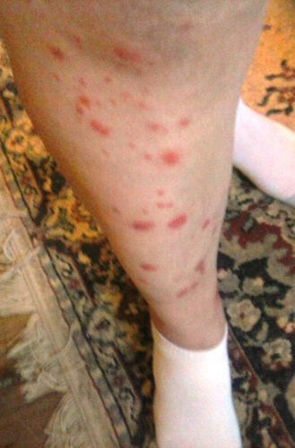bed bug bites econo lodge